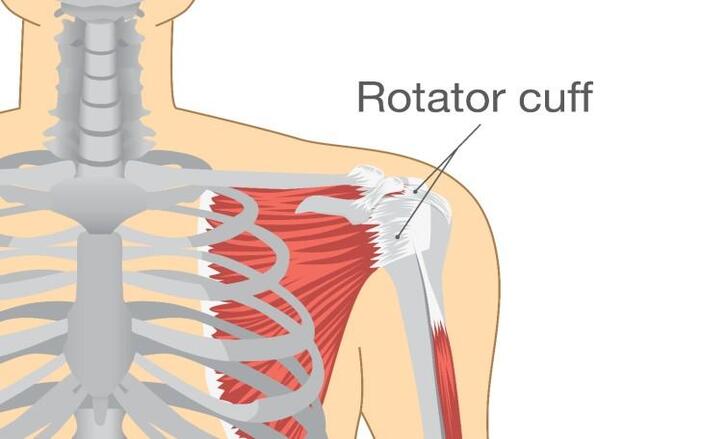 Rotator Cuff Tear